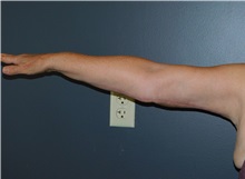 Arm Lift After Photo by Michele DeVito, MD FACS; Scottsdale, AZ - Case 49833