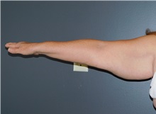 Arm Lift Before Photo by Michele DeVito, MD FACS; Scottsdale, AZ - Case 49833