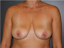 Breast Implant Removal After Photo by Michele DeVito, MD FACS; Scottsdale, AZ - Case 49855