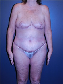 Body Lift After Photo by Michele DeVito, MD FACS; Scottsdale, AZ - Case 49996 Body Lift After Photo by Michele DeVito, MD FACS; Scottsdale, AZ - Case 49996