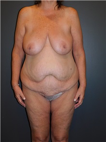 Body Lift Before Photo by Michele DeVito, MD FACS; Scottsdale, AZ - Case 49996 Body Lift Before Photo by Michele DeVito, MD FACS; Scottsdale, AZ - Case 49996