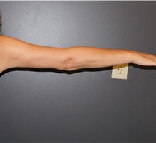 Arm Lift After Photo by Michele DeVito, MD FACS; Scottsdale, AZ - Case 49995 Arm Lift After Photo by Michele DeVito, MD FACS; Scottsdale, AZ - Case 49995