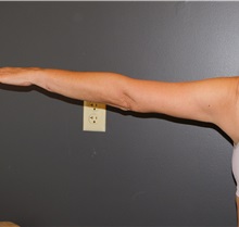 Arm Lift After Photo by Michele DeVito, MD FACS; Scottsdale, AZ - Case 49995
