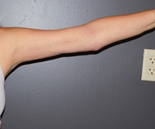 Arm Lift After Photo by Michele DeVito, MD FACS; Scottsdale, AZ - Case 49995