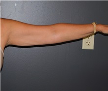 Arm Lift Before Photo by Michele DeVito, MD FACS; Scottsdale, AZ - Case 49995