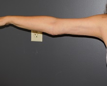 Arm Lift After Photo by Michele DeVito, MD FACS; Scottsdale, AZ - Case 49995