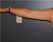 Arm Lift Before Photo by Michele DeVito, MD FACS; Scottsdale, AZ - Case 49995