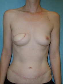 Breast Reconstruction After Photo by David Branch, MD; Bangor, ME - Case 39868