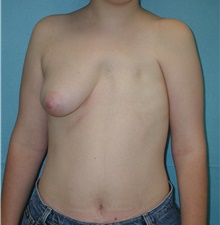 Breast Reconstruction Before Photo by David Branch, MD; Bangor, ME - Case 40003
