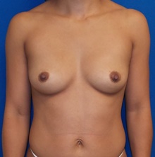 Breast Augmentation Before Photo by Navin Singh, MD; McLean, VA - Case 39656