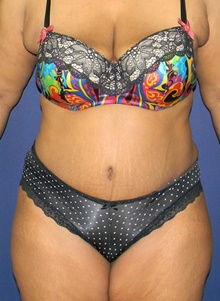 Tummy Tuck After Photo by Navin Singh, MD; McLean, VA - Case 39657