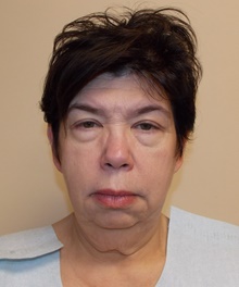 Facelift Before Photo by Navin Singh, MD; McLean, VA - Case 39658