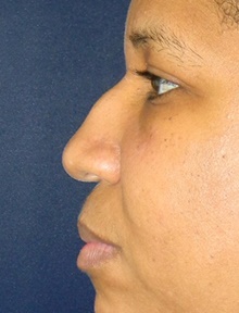 Injectable Fillers Before Photo by Navin Singh, MD; McLean, VA - Case 40074