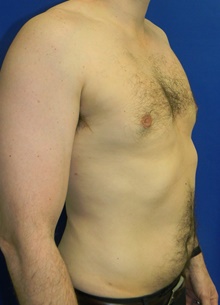 Male Breast Reduction After Photo by Navin Singh, MD; McLean, VA - Case 40075