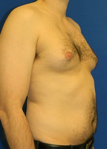 Male Breast Reduction Before Photo by Navin Singh, MD; McLean, VA - Case 40075