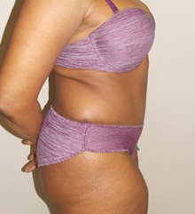 Tummy Tuck After Photo by Navin Singh, MD; McLean, VA - Case 40382