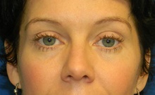 Botulinum Toxin After Photo by Navin Singh, MD; McLean, VA - Case 40383