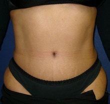 Tummy Tuck After Photo by Navin Singh, MD; McLean, VA - Case 40386