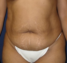 Tummy Tuck Before Photo by Navin Singh, MD; McLean, VA - Case 40386