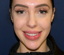Lip Augmentation/Enhancement After Photo by Navin Singh, MD; McLean, VA - Case 40389