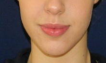 Lip Augmentation/Enhancement Before Photo by Navin Singh, MD; McLean, VA - Case 40389