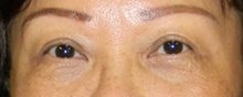 Eyelid Surgery After Photo by Navin Singh, MD; McLean, VA - Case 40653