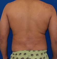 Liposuction After Photo by Navin Singh, MD; McLean, VA - Case 40676
