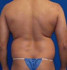 Liposuction Before Photo by Navin Singh, MD; McLean, VA - Case 40676