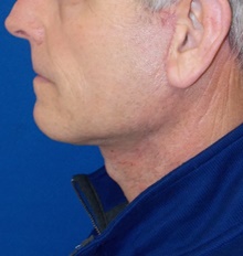 Neck Lift After Photo by Navin Singh, MD; McLean, VA - Case 40678