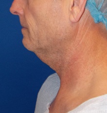 Neck Lift Before Photo by Navin Singh, MD; McLean, VA - Case 40678