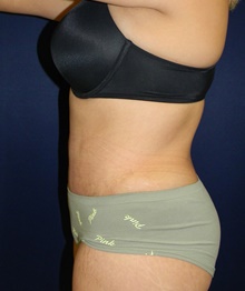 Tummy Tuck After Photo by Navin Singh, MD; McLean, VA - Case 40709