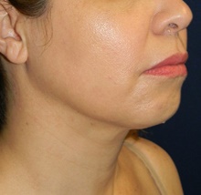 Liposuction After Photo by Navin Singh, MD; McLean, VA - Case 40710