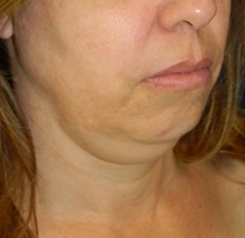 Liposuction Before Photo by Navin Singh, MD; McLean, VA - Case 40710
