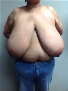 Breast Reduction Before Photo by Anureet Bajaj, MD; Oklahoma City, OK - Case 31426
