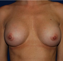 Breast Augmentation After Photo by Robert Kessler, MD; Corona Del Mar, CA - Case 35773