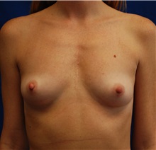 Breast Augmentation Before Photo by Robert Kessler, MD; Corona Del Mar, CA - Case 35773
