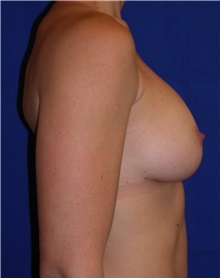 Breast Augmentation After Photo by Robert Kessler, MD; Corona Del Mar, CA - Case 35778