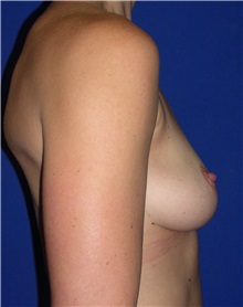 Breast Augmentation Before Photo by Robert Kessler, MD; Corona Del Mar, CA - Case 35778