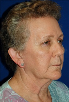 Eyelid Surgery After Photo by Robert Kessler, MD; Corona Del Mar, CA - Case 35792