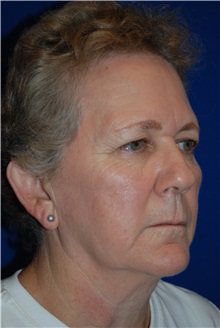 Eyelid Surgery Before Photo by Robert Kessler, MD; Corona Del Mar, CA - Case 35792