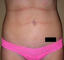 Liposuction After Photo by Robert Kessler, MD; Corona Del Mar, CA - Case 35794