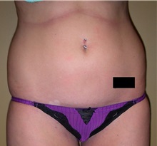 Liposuction Before Photo by Robert Kessler, MD; Corona Del Mar, CA - Case 35794
