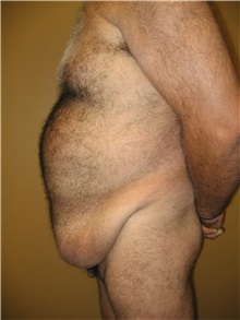 Tummy Tuck Before Photo by Robert Kessler, MD; Corona Del Mar, CA - Case 35796