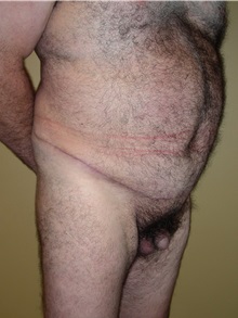 Tummy Tuck After Photo by Robert Kessler, MD; Corona Del Mar, CA - Case 35796