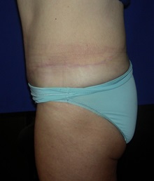 Tummy Tuck After Photo by Robert Kessler, MD; Corona Del Mar, CA - Case 35798