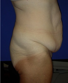 Tummy Tuck Before Photo by Robert Kessler, MD; Corona Del Mar, CA - Case 35798