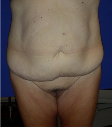 Tummy Tuck Before Photo by Robert Kessler, MD; Corona Del Mar, CA - Case 35798