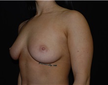 Breast Augmentation Before Photo by Robert Kessler, MD; Corona Del Mar, CA - Case 35871