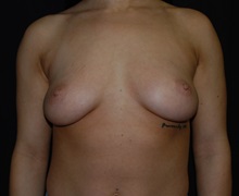 Breast Augmentation Before Photo by Robert Kessler, MD; Corona Del Mar, CA - Case 35872