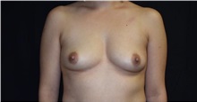 Breast Augmentation Before Photo by Robert Kessler, MD; Corona Del Mar, CA - Case 37910